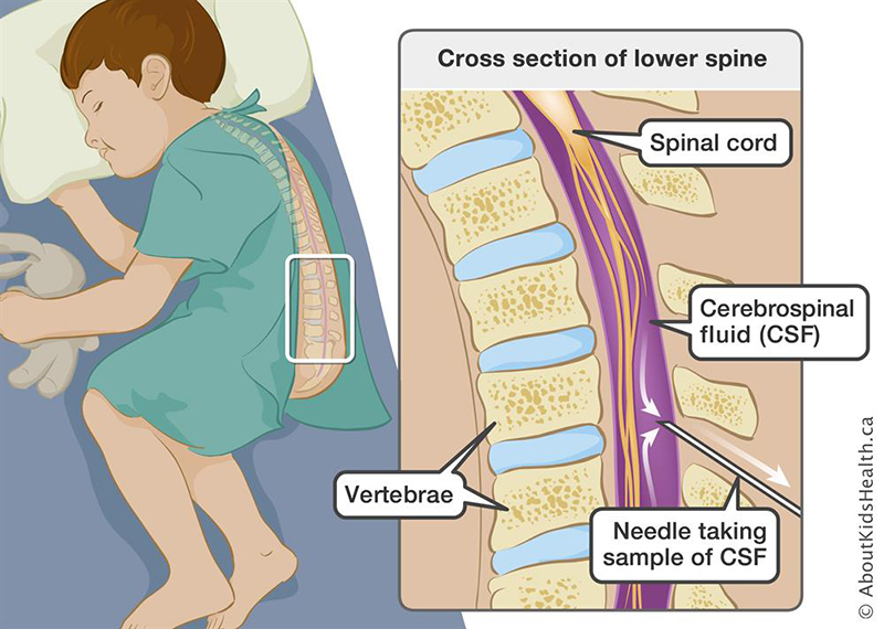 Define Lumbar Puncture In Biology